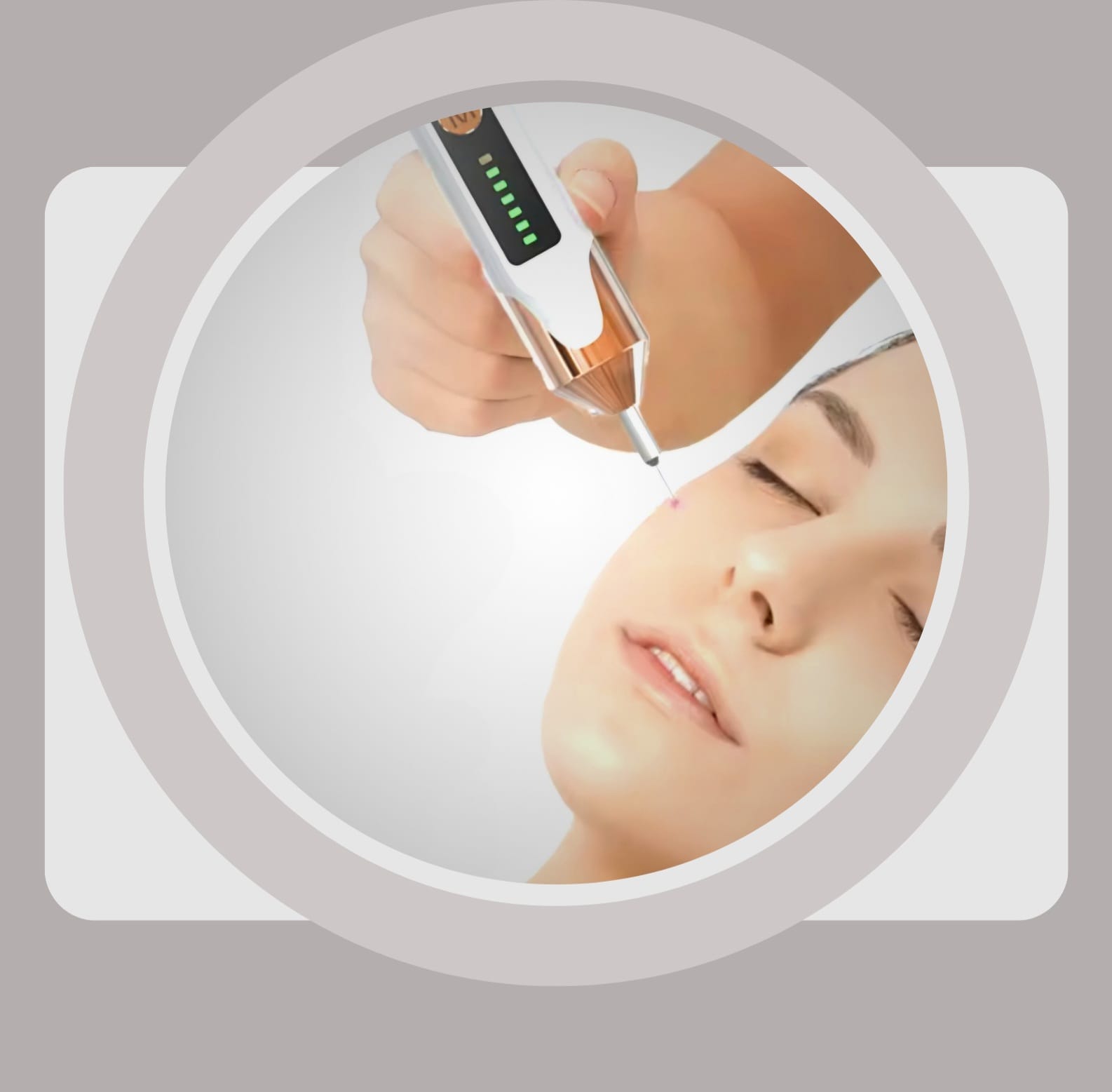 BB Remover Entfernung